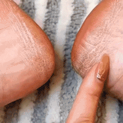 ELECTRIC PEDI CALLUS REMOVER