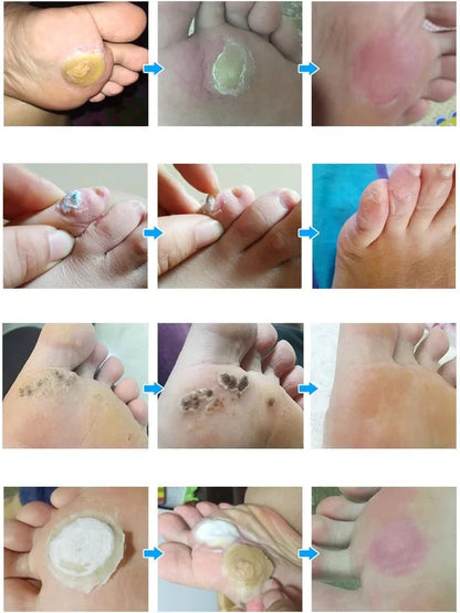 【Apply and peel】Corn remover