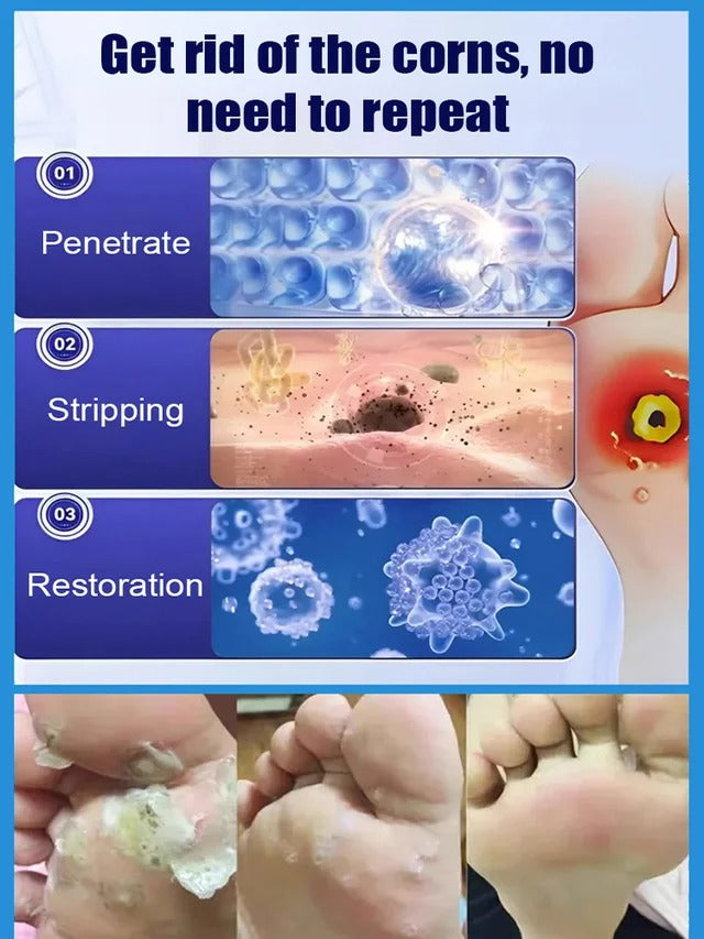 【Apply and peel】Corn remover